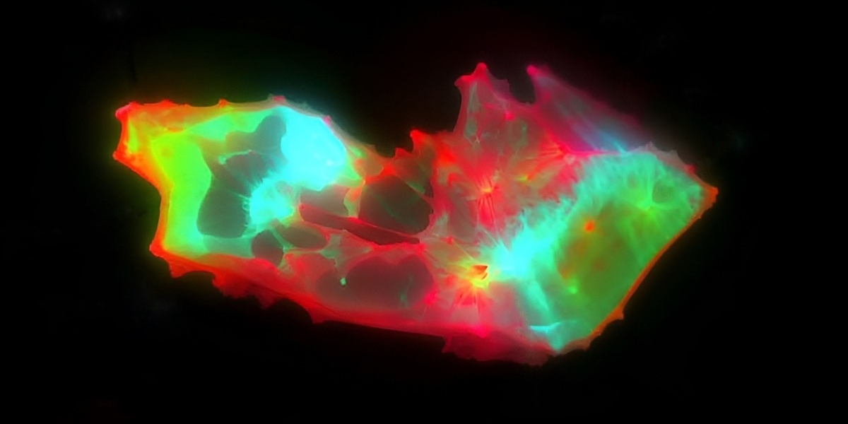 В крови людей с постковидом нашли странные структуры — они могут объяснить затяжные симптомы