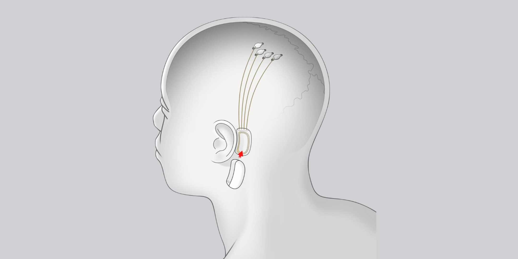 Что заменит смартфоны: схема имплантации Neuralink